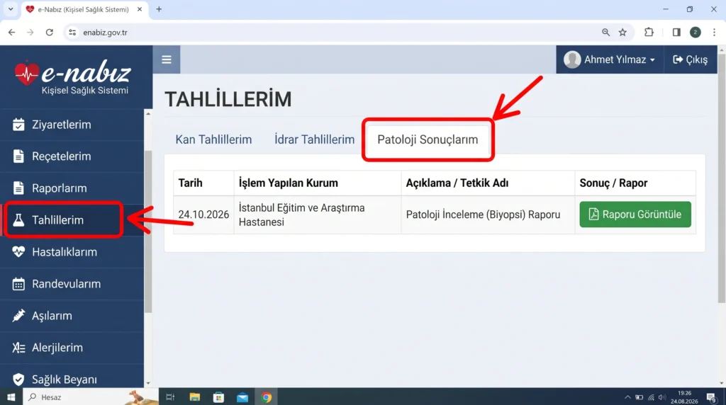 e-Nabız sistemi üzerinden tahlillerim menüsüne girerek patoloji sonucu öğrenme ekranının adım adım gösterimi.